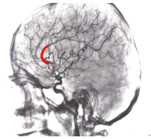 图中红色部分是大脑前动脉哪一段 