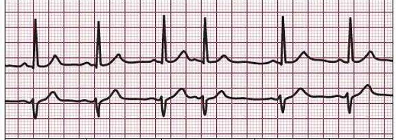 如图所示为该心电图可能的诊断为