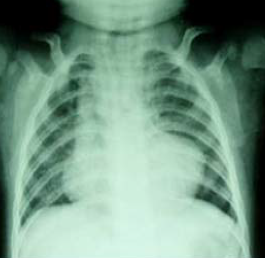 男性先天性心脏病患儿，10岁，因青紫发绀入院，X线胸片如图所示，她最可能的诊断是（） 