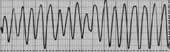 心电图检查如图所示，请写出心电图诊断