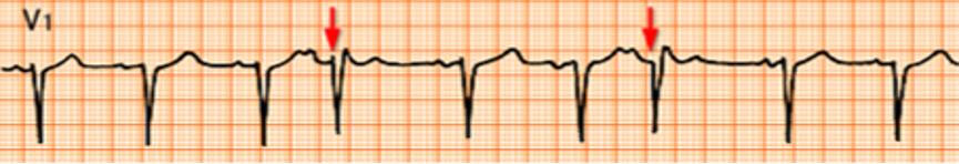 下图所示心电图，最可能的诊断是