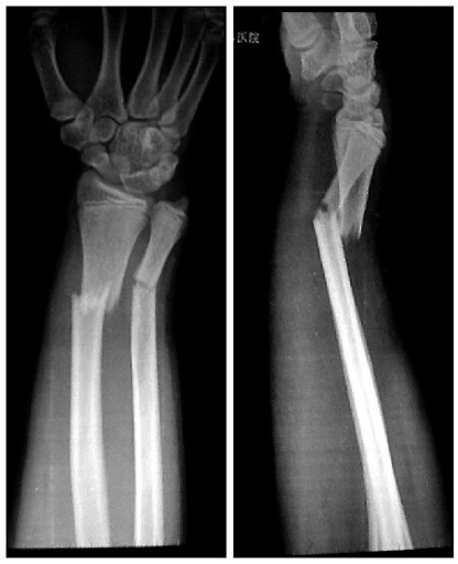 左图是X线正位片（前后拍摄），右图是正侧位片（左右拍摄），对骨折描述正确的是什么？ 