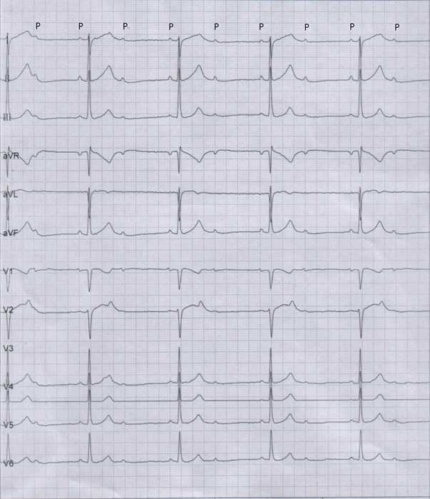 女，43岁，因心悸、胸闷就诊，心电图如图所示，应诊断为