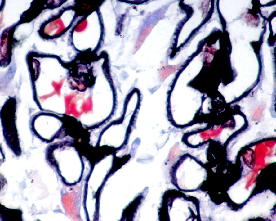 下面的肾小球PASM染色图片与哪种疾病的形态契合？ 