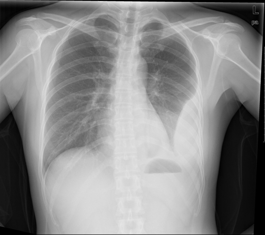 患者，女，35岁 ，反复胸闷8月余 ，X线查如下图，请问最有可能的诊断是什么？ 