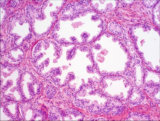 Which of the following histologic slides shows car