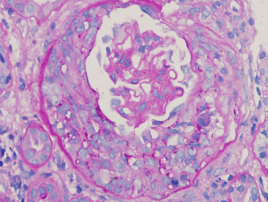 某患者肾穿刺病理检查，样本中大部分肾小球存在下面图片中的病变，IgG免疫荧光沿肾小球毛细血管壁分布，