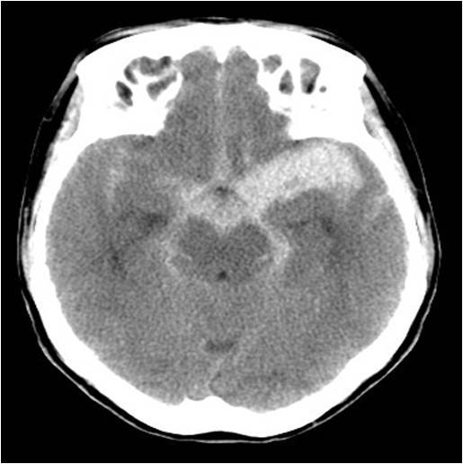 患者，男，42岁，因“突发头剧烈头痛2小时”入院急诊CT图像如图示，你的考虑是