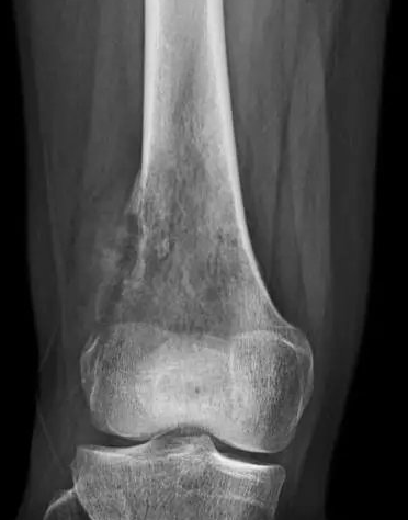 女，20岁，右膝疼痛1月余，X线如图示，最可能的诊断是 