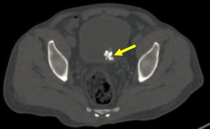 男性，60岁，排尿困难，下图是他的盆腔CT平扫图像，你认为箭头所示的高密度结石在哪里？（） 