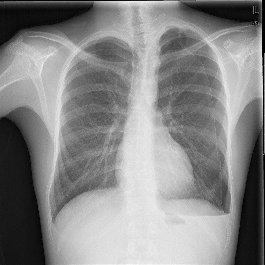 患者，男，左侧胸痛3天。深呼吸时明显。少量咳嗽咳痰。X线查如下图，请问最合适的诊断是什么？ 