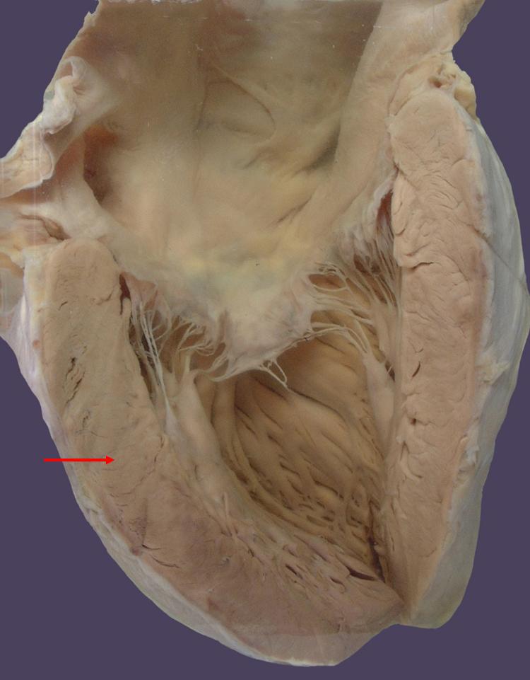 图中所示高血压病患者增厚的左心室室壁，属于 