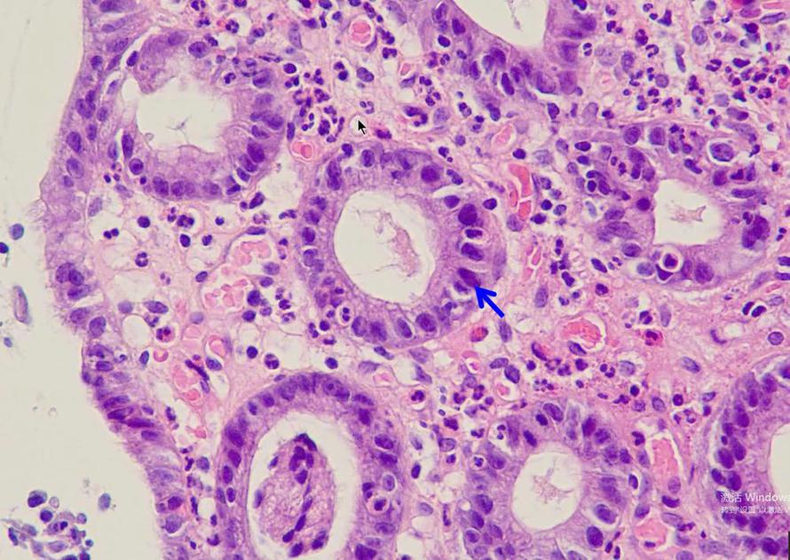 下列哪张图片中，蓝色箭头所示部位可反映慢性胃炎黏膜组织中具有急性活动性病变