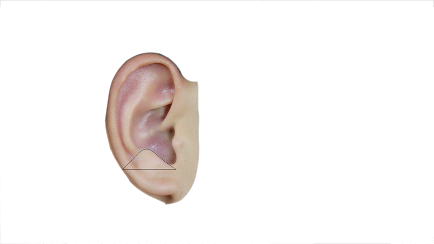 根据耳穴分布规律，面颊部对应的耳穴分布在