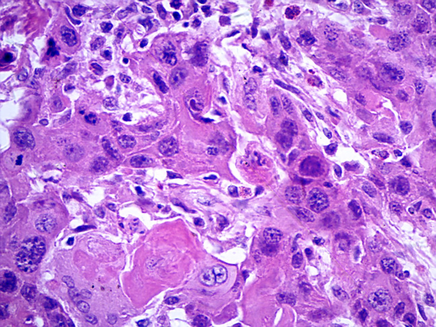 下面哪种细胞是霍奇金淋巴瘤中的木乃伊细胞