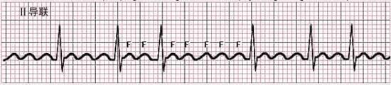 心电图检查如图所示，该心电图诊断为 