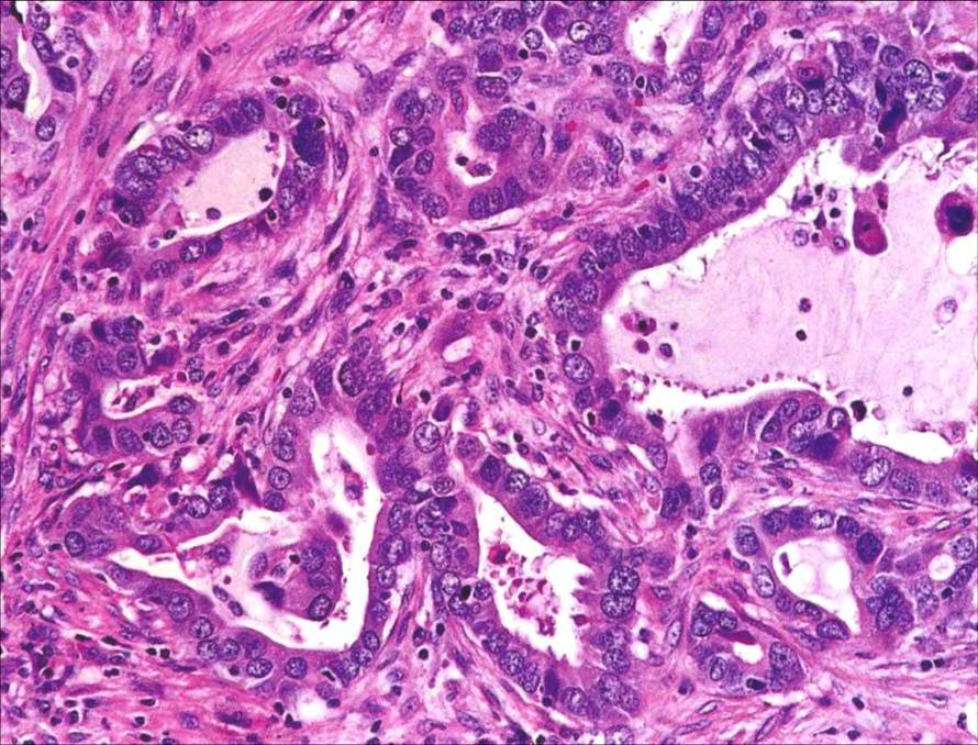 Which picture is the adenocarcinoma of lung？