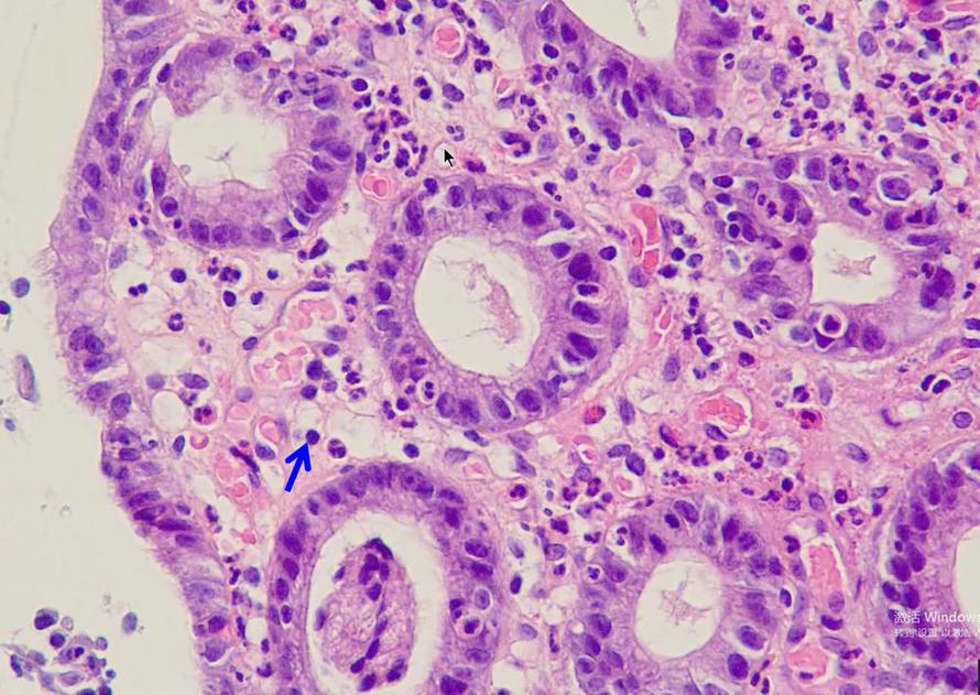 下列哪张图片中，蓝色箭头所示部位可反映慢性胃炎黏膜组织中具有急性活动性病变