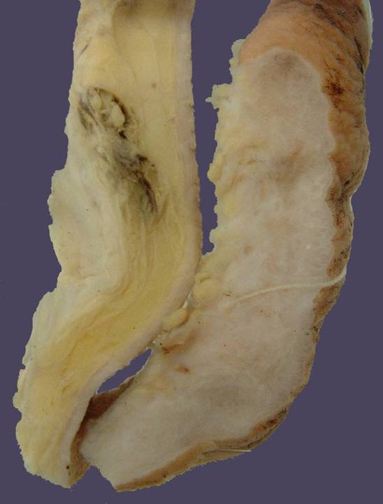 与左侧正常皮肤组织相比较右侧皮肤组织发生了