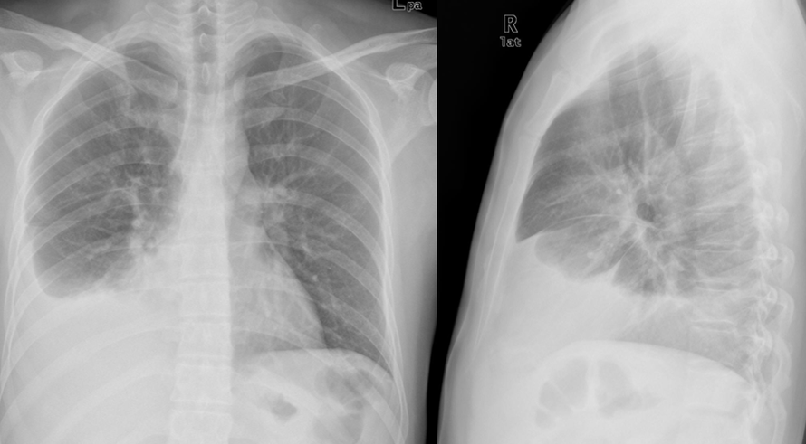 胸腔积液x线图片