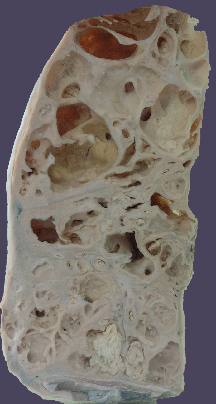 支气管扩张对应的图片是